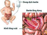 C&aacute;ch ph&aacute;t hiện v&agrave; ngăn ngừa lồng ruột ở trẻ 1