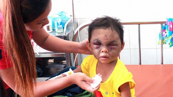 Những vết thương trên cơ thể sẽ lành, nhưng tổn thương tâm hồn của bé Ngân sẽ còn lại rất lâu