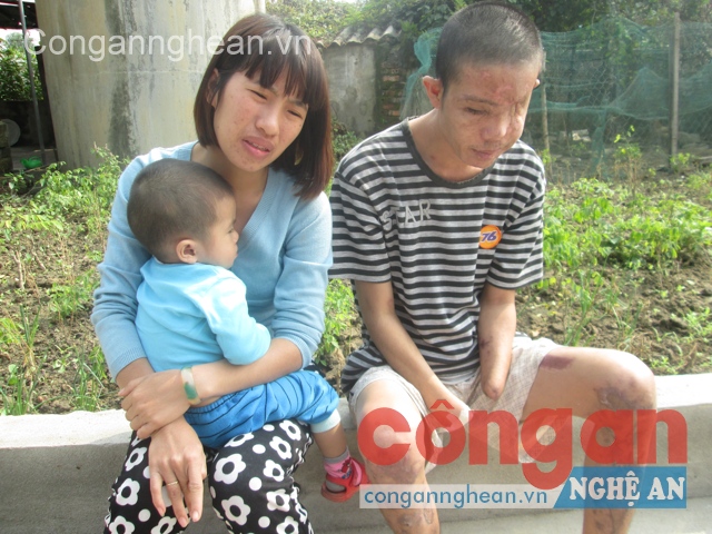 Sau vụ nổ, anh Thái Viết Hảo hoàn toàn không làm được gì,  sức khỏe giảm sút nghiêm trọng
