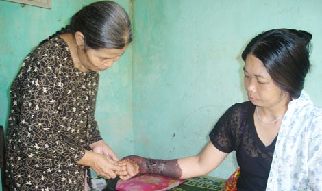 Bà Liên đang bôi thuốc cho một bệnh nhân.