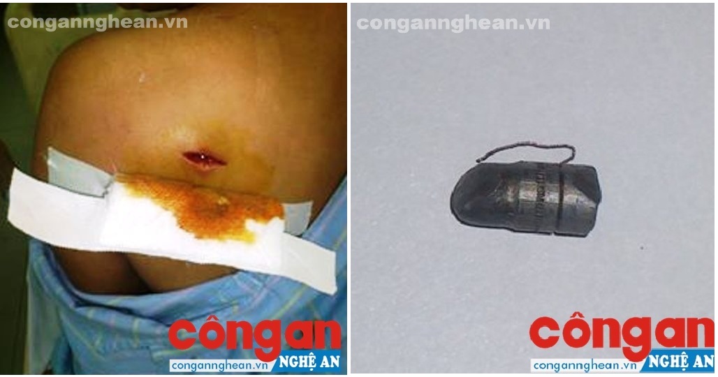 Vết thương và viên đạn được gắp ra từ cơ thể bà Tý