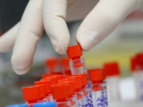 Mẫu xét nghiệm HIV