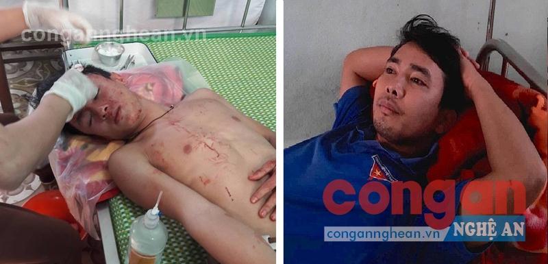 Học trò (bị khâu 10 mũi) cùng thầy giáo phải nhập viện trong vụ việc bị 3 đối tượng hành hung tại Trường THPT Lê Lợi