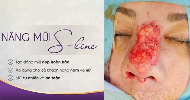 Một nạn nhân bị hoại tử mũi khi tiêm chất làm đầy tại cơ sở làm đẹp không đảm bảo.