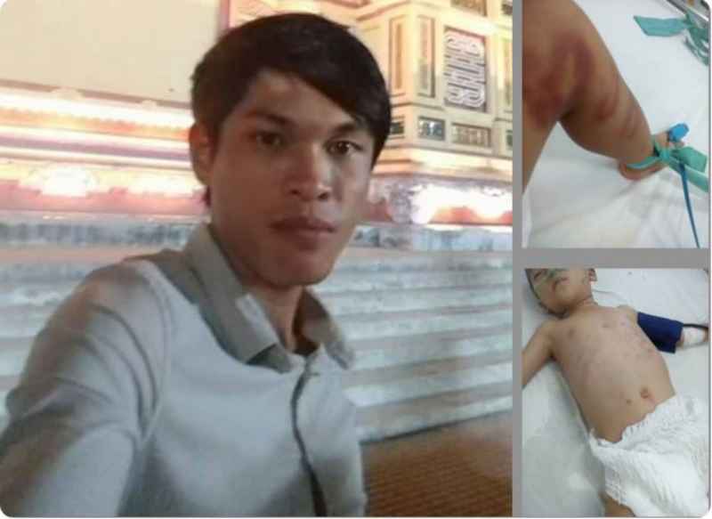 Gã cha dượng hờ đã khiến cháu bé thương tật nặng