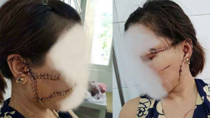 Chị O. với những vết thường chằng chịt trên mặt