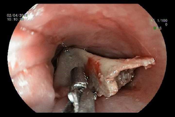 Vừa ăn vừa nói chuyện, xem tivi, đọc chuyện... rất nguy hiểm cho trẻ. Ảnh xương gà mắc trong thực quản bé gái tại Bình Dương năm 2018. Nguồn: Internet