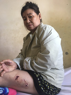 Bà Nguyễn Thị Tuyết Nhung bị chó của nhà bà Hoàng Thị Mỹ Tín cắn, cào cấu gây thương tích ở đùi.