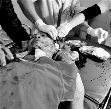 Đồng chí Nguyễn Tuấn Lộc bị các đối tượng chém trọng thương ở vùng đầu