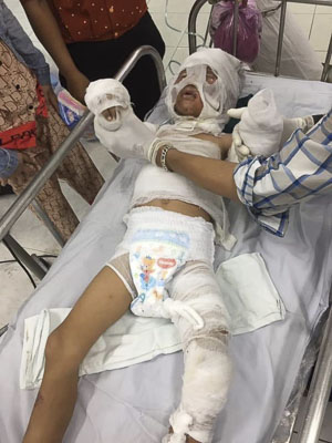 Cháu Hồ Tuấn V. với vết bỏng nặng hơn 50% cơ thể đang được chữa trị tại Bệnh viện Nhi Đồng 2, TP.Hồ Chí Minh. 