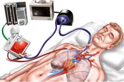 ECMO là gì? Khi nào bệnh nhân cần can thiệp ECMO?