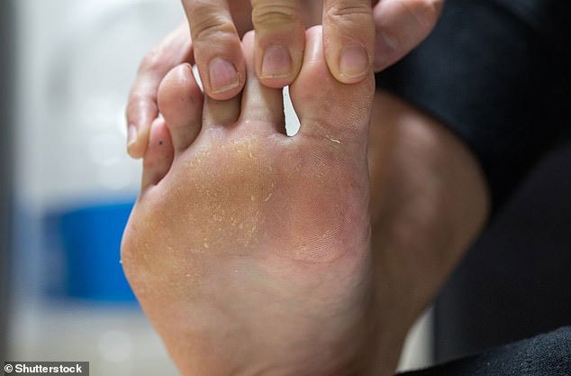 Rỗ da chân là một trong những nguyên nhân khiến chân luôn có mùi hôi.