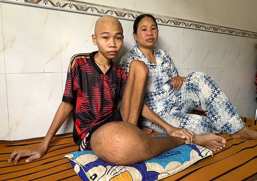 Sau 3 đợt hoá trị, Hoàng và mẹ chuẩn bị khăn gói lên TP. Hồ Chí Minh để làm phẫu thuật với chi phí khá lớn trong khi điều kiện gia đình ngặt nghèo.