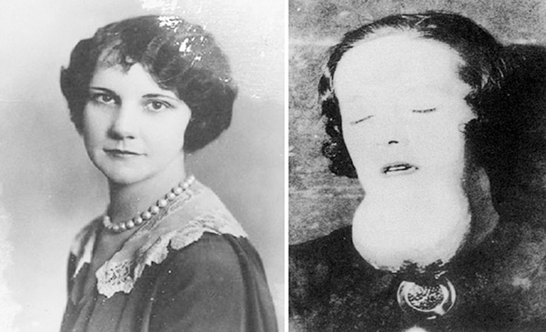 Grace Fryer lúc chưa đi làm cho USRC và khối u khổng lồ dưới cằm khi đã nhiễm Radium.