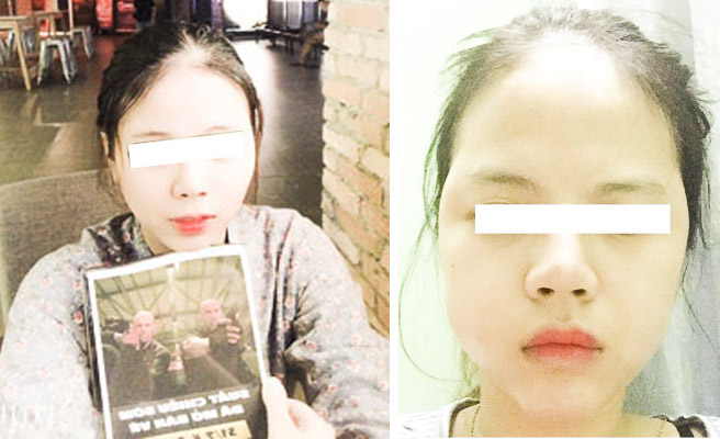 Gương mặt của chị V.T.T. trước và sau khi tiêm filler tại cơ sở làm đẹp N.S.S.&C. (phường 4, TP.Vũng Tàu).
