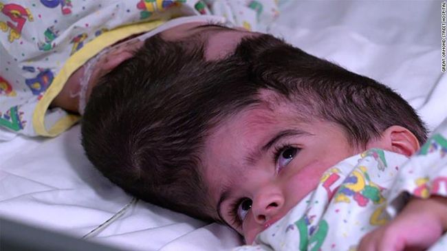 Safa và Marwa lúc chưa phẫu thuật tách rời hộp sọ.