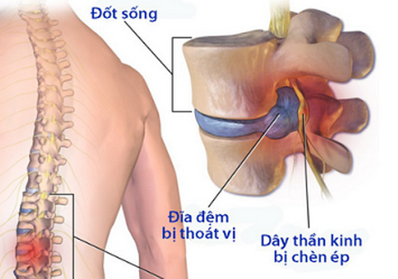 Hình ảnh thoát vị đĩa đệm trên cộng hưởng từ.