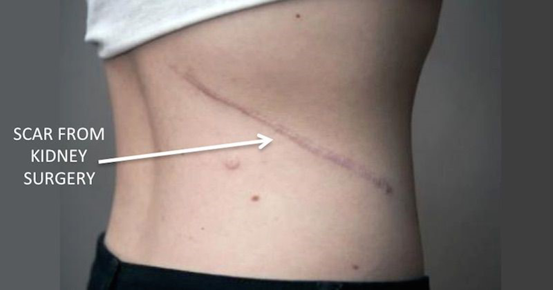 Sẹo sau phẫu thuật mổ mở