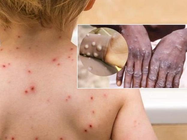 Bệnh đậu mùa khỉ và bệnh thủy đậu đều do virus gây ra nhưng vẫn có sự khác biệt. Ảnh: Website Bộ Y tế