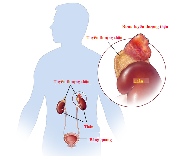 Minh họa giải phẫu u tuyến thượng thận.
