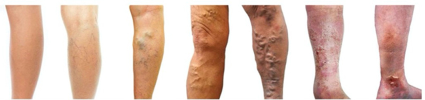 Các mức độ suy tĩnh mạch chi dưới: Từ trái qua, Chi dưới bình thường, Suy độ 1, 2, 3, 4, 5, 6.