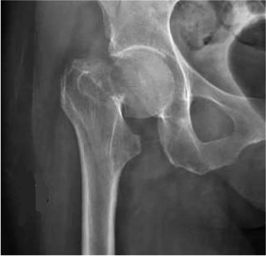 Hình ảnh X quang cho thấy cổ xương đùi bị gãy.