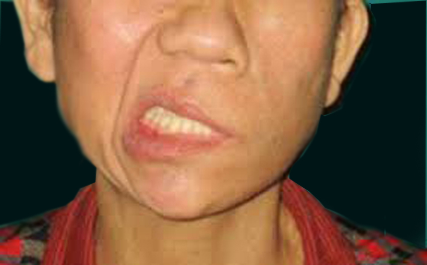 Liệt mặt do tổn thương thần kinh số 7 chứ không phải trúng gió.