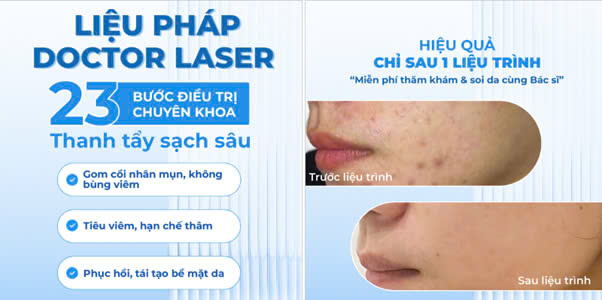 Kết quả điều trị mụn thực tế của khách hàng Phương Lan sau khi sử dụng phác đồ Doctor Laser với làn da láng mịn
