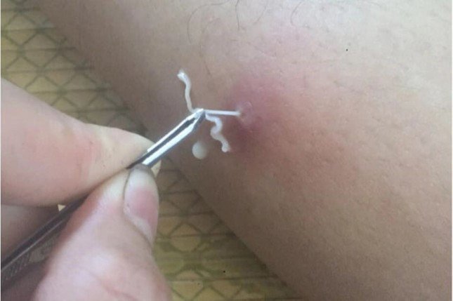 Một “giun rồng” được lấy ra khỏi cơ thể người, các chuyên gia WHO cho rằng đây là loài mới. Ảnh: BSCC